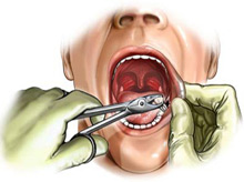 dental_extraction_drawing